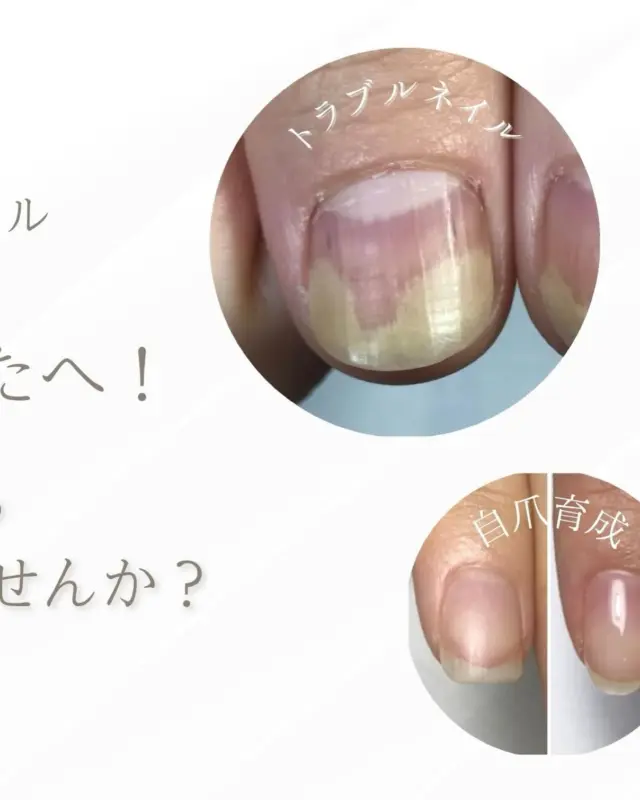 @riche.nail でサロン情報更新中💅🏻

📍柏駅徒歩5分｜深爪・自爪育成ネイルサロン Riche（リッシェ）です✨

【爪の育成を軸にリニューアル💅🏻】
Richeは今年10周年を迎えます😊
2018年から取り組んできた「深爪・自爪育成」を軸に
爪にお悩みがある方を対象にもっと深い、
根本的な部分からサポートできるよう新メニューを導入いたします✨

⭐️新メニュー

①トラブルネイル
ーーーーーーーーーーーーーーーーーーーーーーーー
☑︎重度の深爪で悩んでいる方
☑︎爪の剥離や凹凸のボコボコした爪でお悩みの方
☑︎この状態でネイルサロンに行っていいのかな？とお悩みの方

などを対象に、
身体の内側からの影響も考えながら整えるコースです😊

ーーーーーーーーーーーーーーーーーーーーーーーー

②剥がせるジェルネイル
ーーーーーーーーーーーーーーーーーーーーーーーー
☑︎剥がしてオフができる新感覚のピールオフジェル
☑︎結婚式やイベントの時だけネイルがしたいという方
☑︎オフの際に削って出るダストが気になるという方
☑︎妊婦さんや急に病院に行く可能性がある方

などに向いている
自分でも簡単にオフが出来るジェルネイル💅🏻
ーーーーーーーーーーーーーーーーーーーーーーーー

今までの自爪育成・上品ネイルをベースに
もっともっとネイルを楽しめる方が増えたらと
新しいメニューを導入することにしました☺️

①のトラブルネイルコースに関しましては
6月末からモニター募集を開始する予定です。

気になる方はLINE登録して
『トラブルネイルモニター」と
トークに送ってください✨

詳細をお送りさせていただきます！

📩 公式LINEは
→ @riche.nail のプロフィール下リンクより

📌サロン情報
深爪・自爪育成ネイルサロン Riche（リッシェ）

〒277-0841
千葉県柏市あけぼの4-4-5 コンフォート203
柏駅西口徒歩5分｜完全予約制

定休日：水曜・木曜